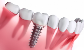 Dental Insurance for implants