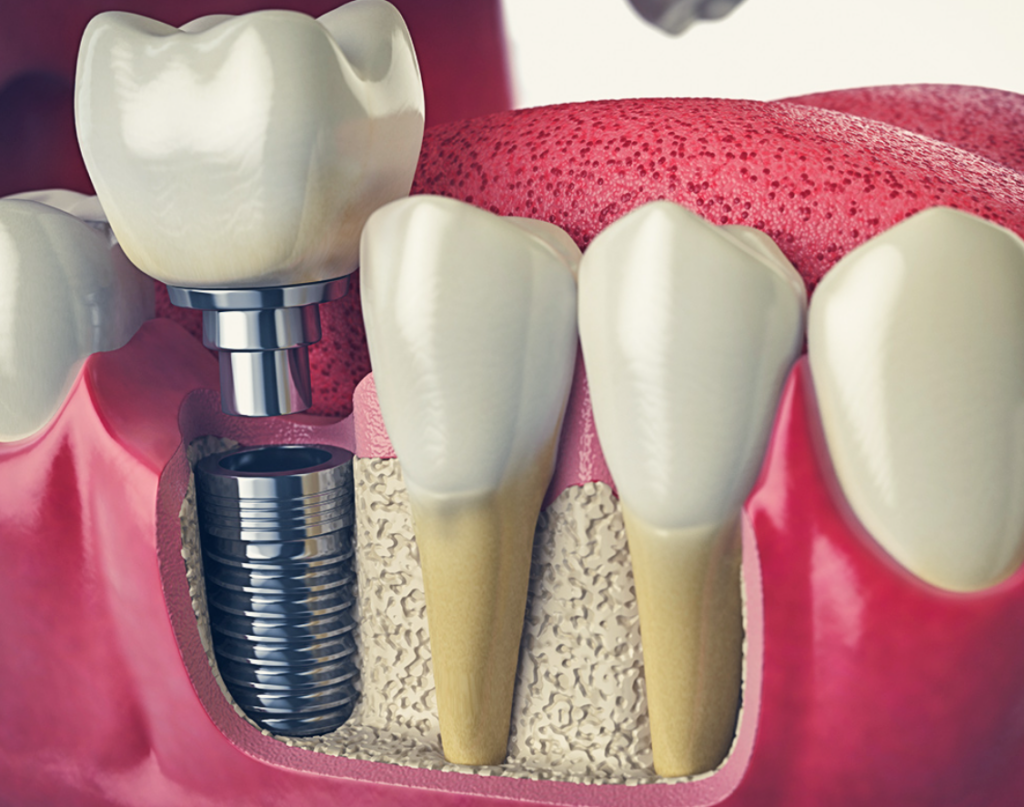 Dental Implants and Insurance