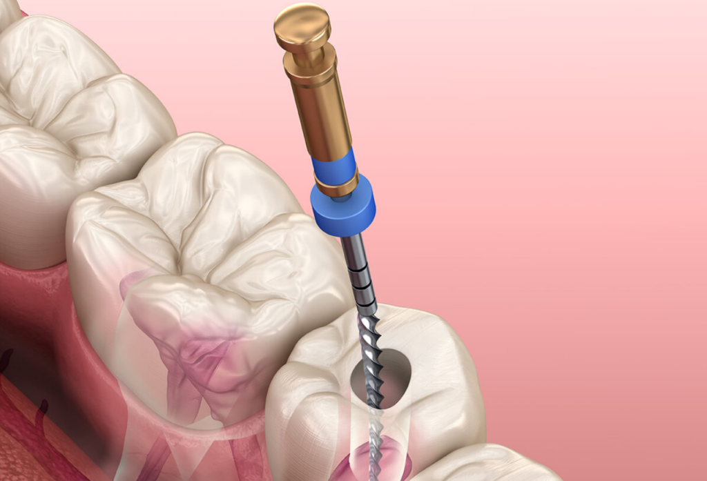 emergency root canal treatment