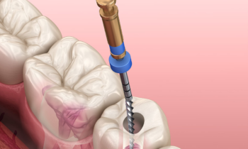emergency root canal treatment