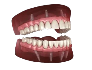 teeth implants in one day