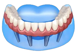 Cost of Hybrid Dentures Implants