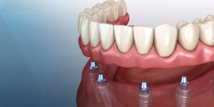 cosmetic dentistry and implants