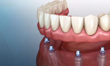 implant supported dentures