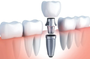 dental implants