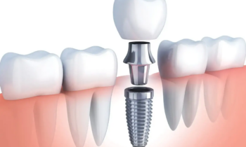 dental implants