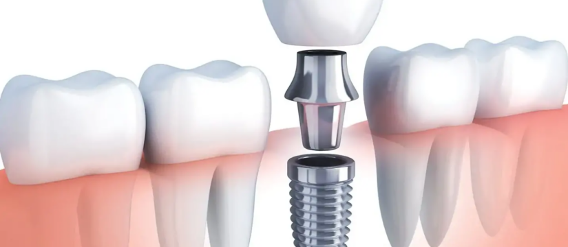 dental implants