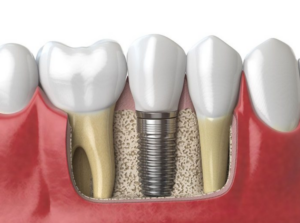 bone grafting procedure for dental implants