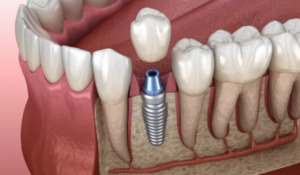 Dental Implants cost