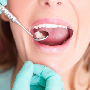 Problems with All-on-4 Dental Implants