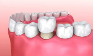 Benefits of Choosing Porcelain Crowns