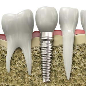 dental bone graft implant