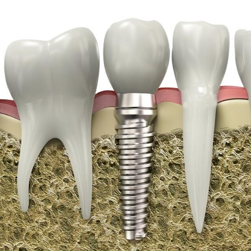 dental implants