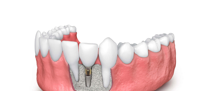 Dental Implants and Bone Grafting