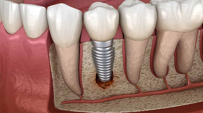 bone grafting and dental implants