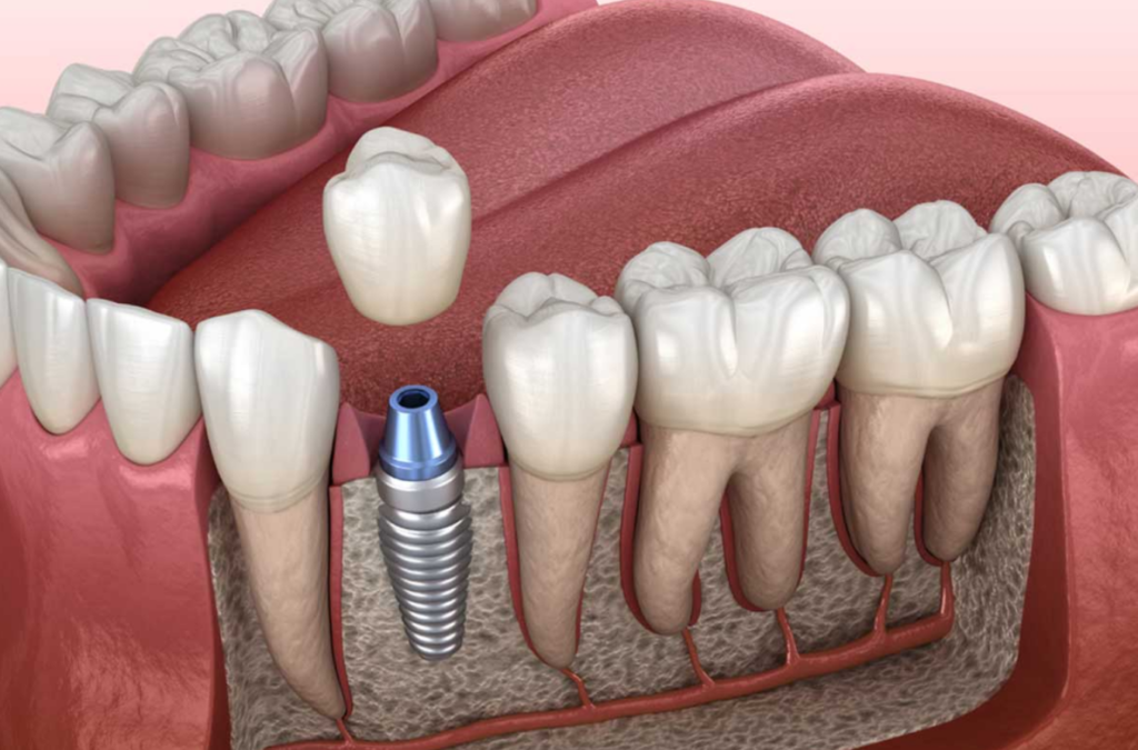 Single dental implant