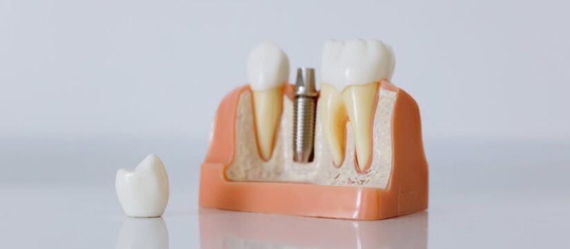 Full Mouth Implants vs. Dentures: Making the Right Choice for Your Smile