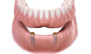 Dental Implants for Seniors: Restore Your Smile at Any Age