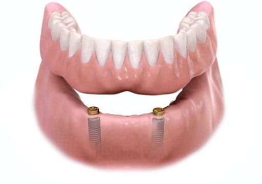 dental implants