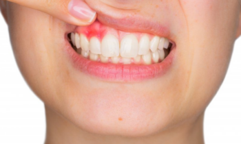 gum disease causes and prevention