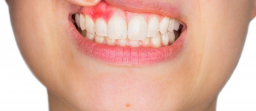 gum disease causes and prevention