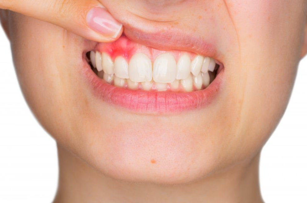 gum disease causes and prevention