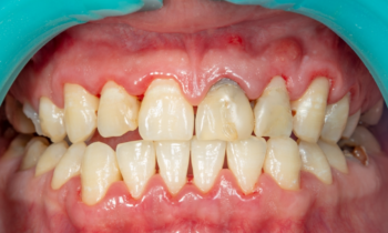 Understanding and Preventing Gum Disease