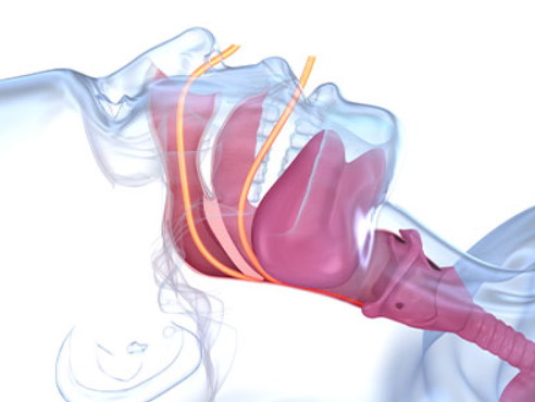 sleep apnea and dental health