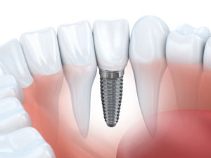 reasons dental implants are best
