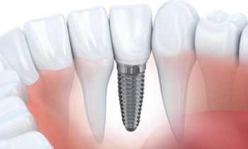 reasons dental implants are best