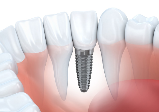 reasons dental implants are best