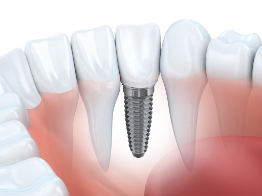 reasons dental implants are best