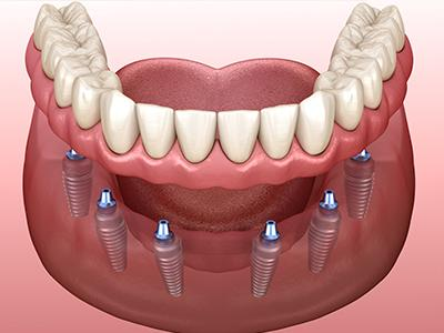 dental implants are best solution 