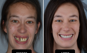 LP - Full Mouth Dental Implants