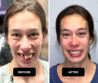 LP - Full Mouth Dental Implants