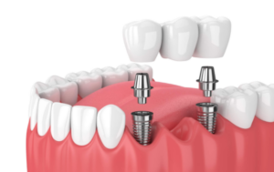 Dental implants illustration