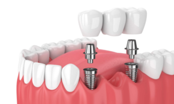 Dental implants illustration