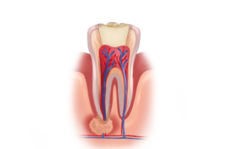 Illustration of a tooth with inflamed root and infection