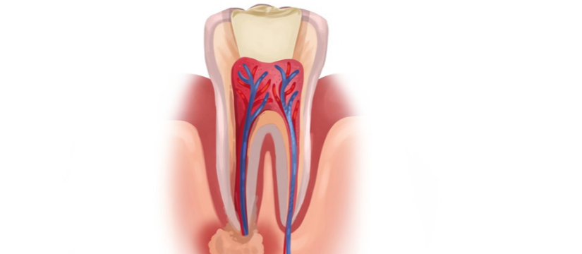 Illustration of a tooth with inflamed root and infection