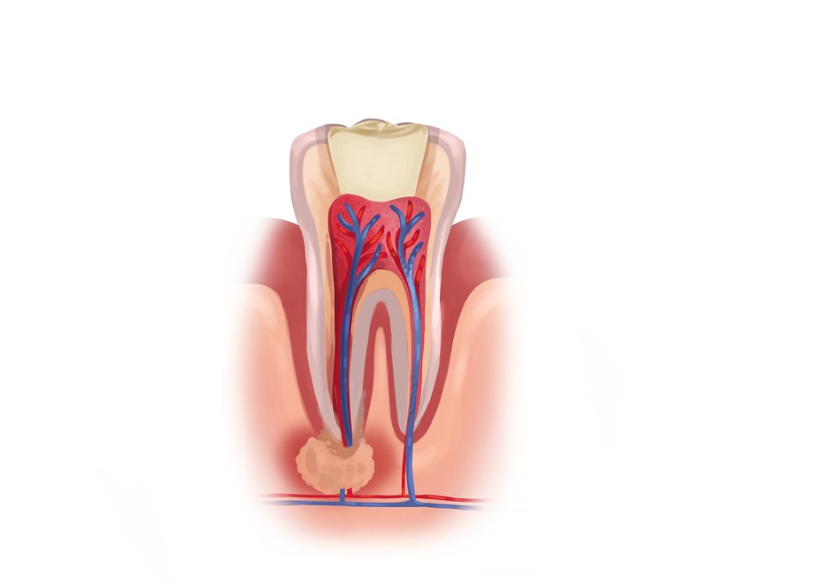 Illustration of a tooth with inflamed root and infection