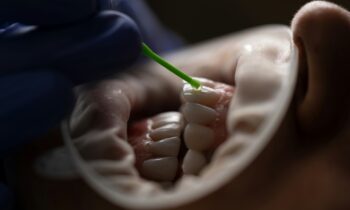 Root Canals vs. Tooth Extraction