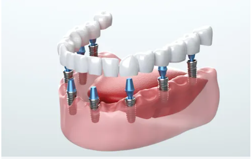 Dental implants 