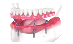 Hybrid Dentures Implants