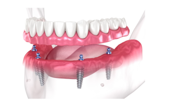 Dentures with implants diagram