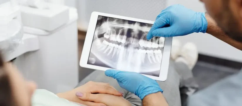 ¿Qué son los implantes dentales y cómo funcionan?