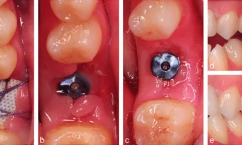 Dental Implant Healing Stages