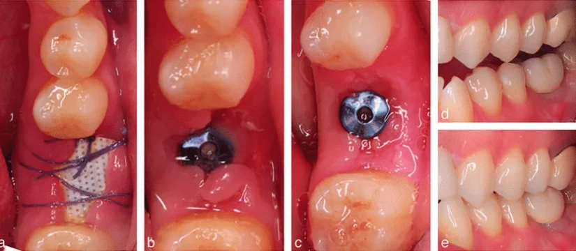 Dental Implant Healing Stages