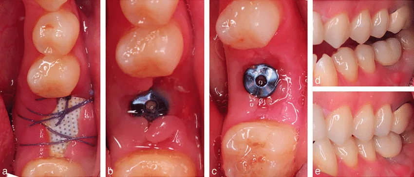 Dental-Implant-Healing-Stages