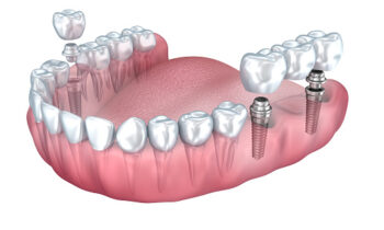 Multiple Tooth Replacement