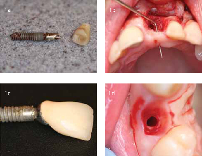 Dental Implant Fails